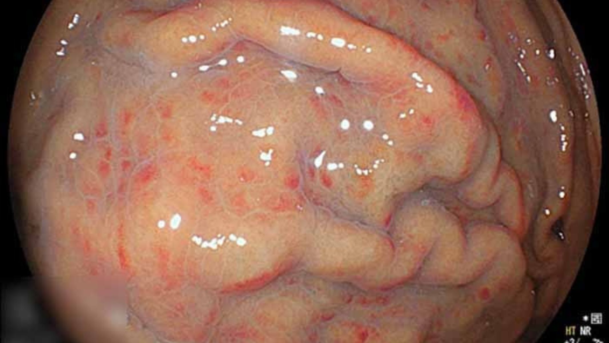 Hình ảnh viêm loét dạ dày tá tràng: Phù nề niêm mạc