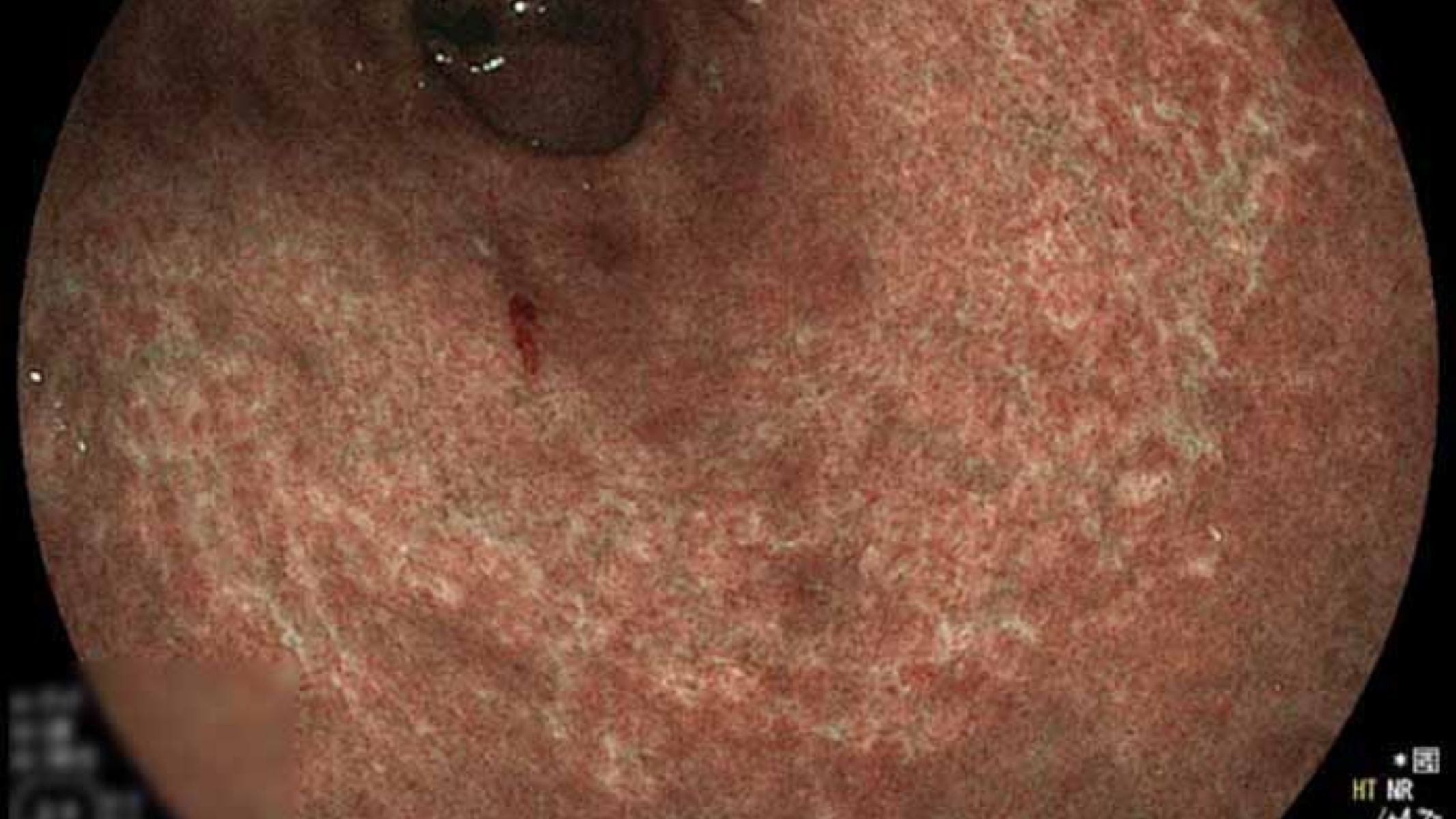 Hình ảnh teo niêm mạc và dị sản ruột