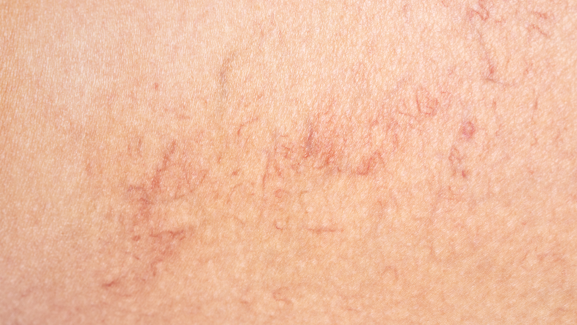 Giãn mao mạch mặt là tình trạng các mạch máu li ti dưới da bị giãn nở bất thường