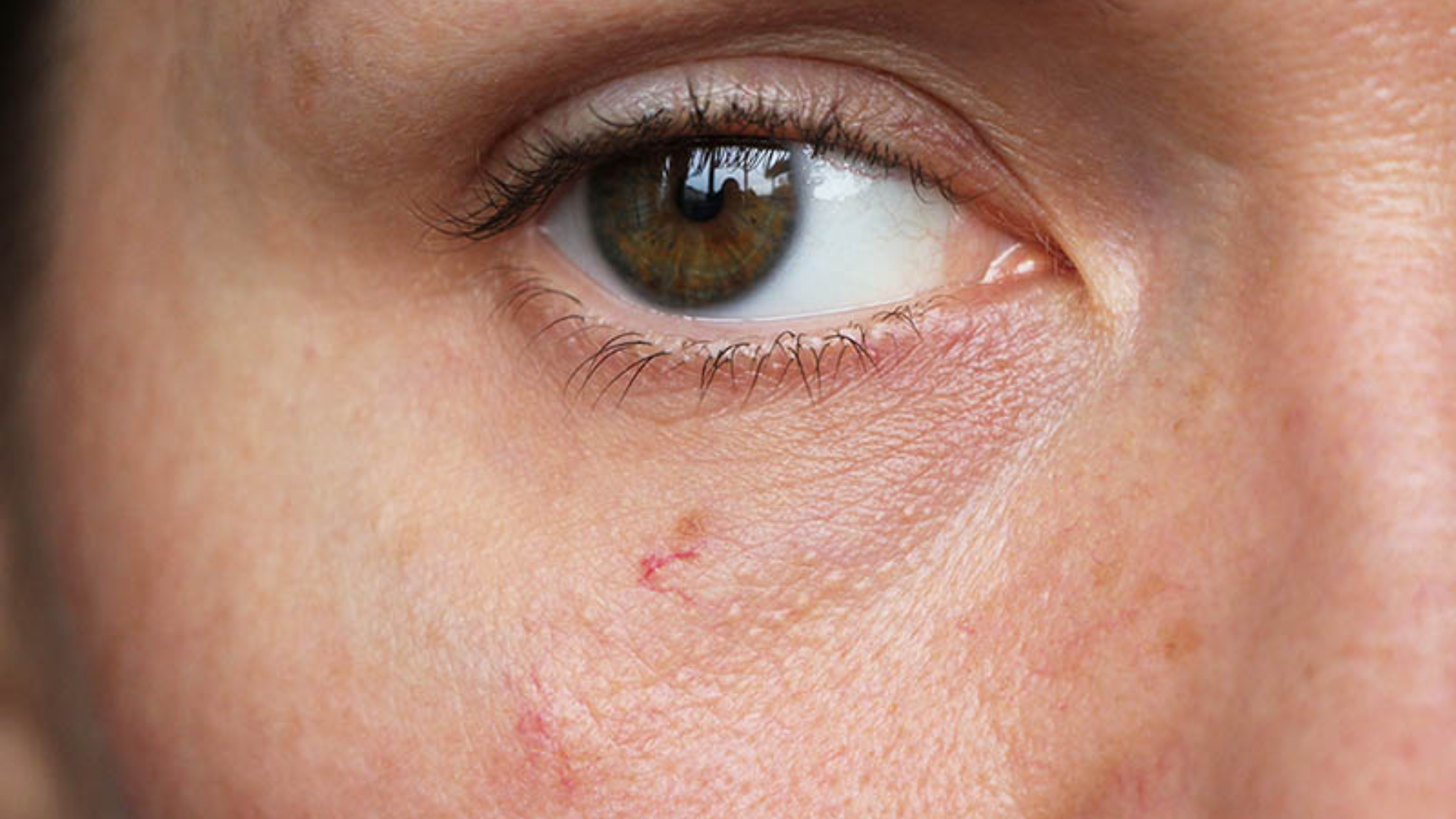 Tình trạng giãn mao mạch mặt thường gặp ở người trưởng thành, đặc biệt phụ nữ có làn da nhạy cảm