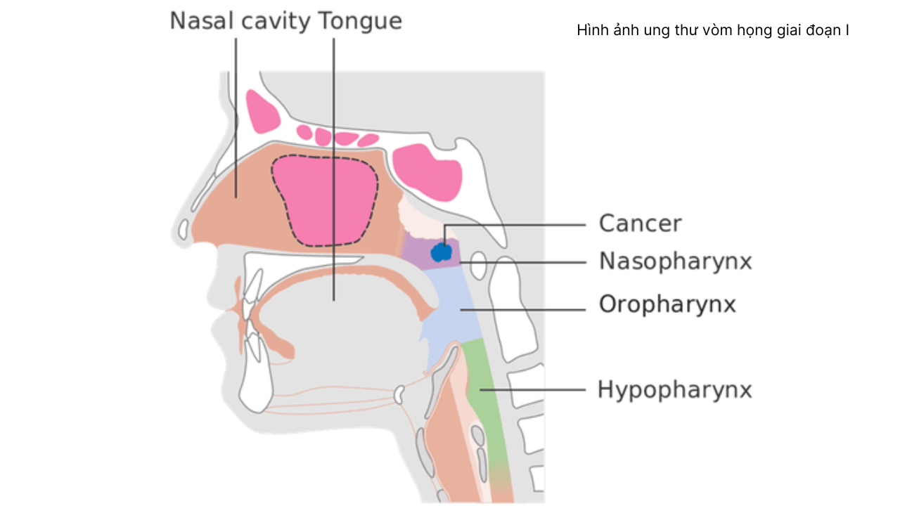 nhan-biet-hinh-anh-ung-thu-vom-hong (2).png