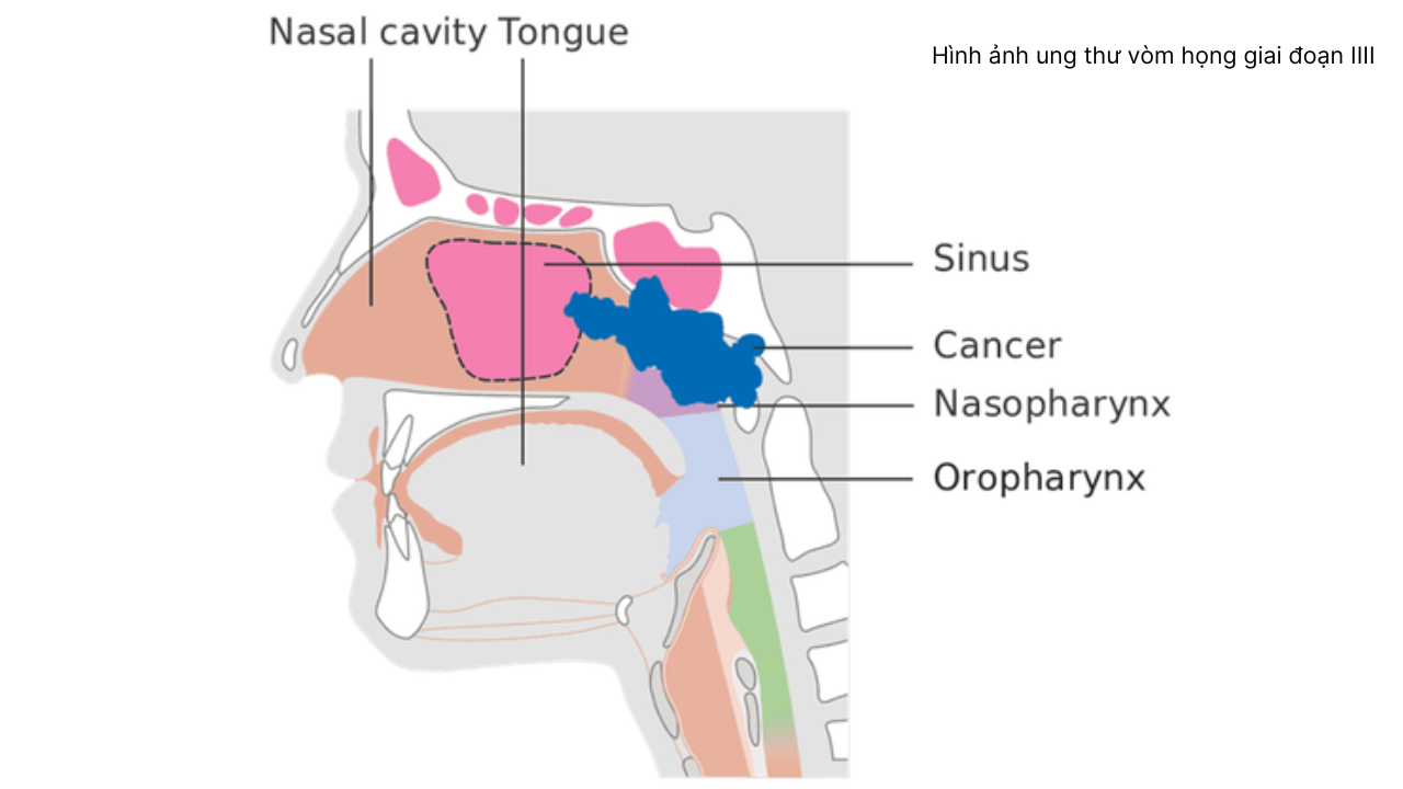 nhan-biet-hinh-anh-ung-thu-vom-hong (4).png