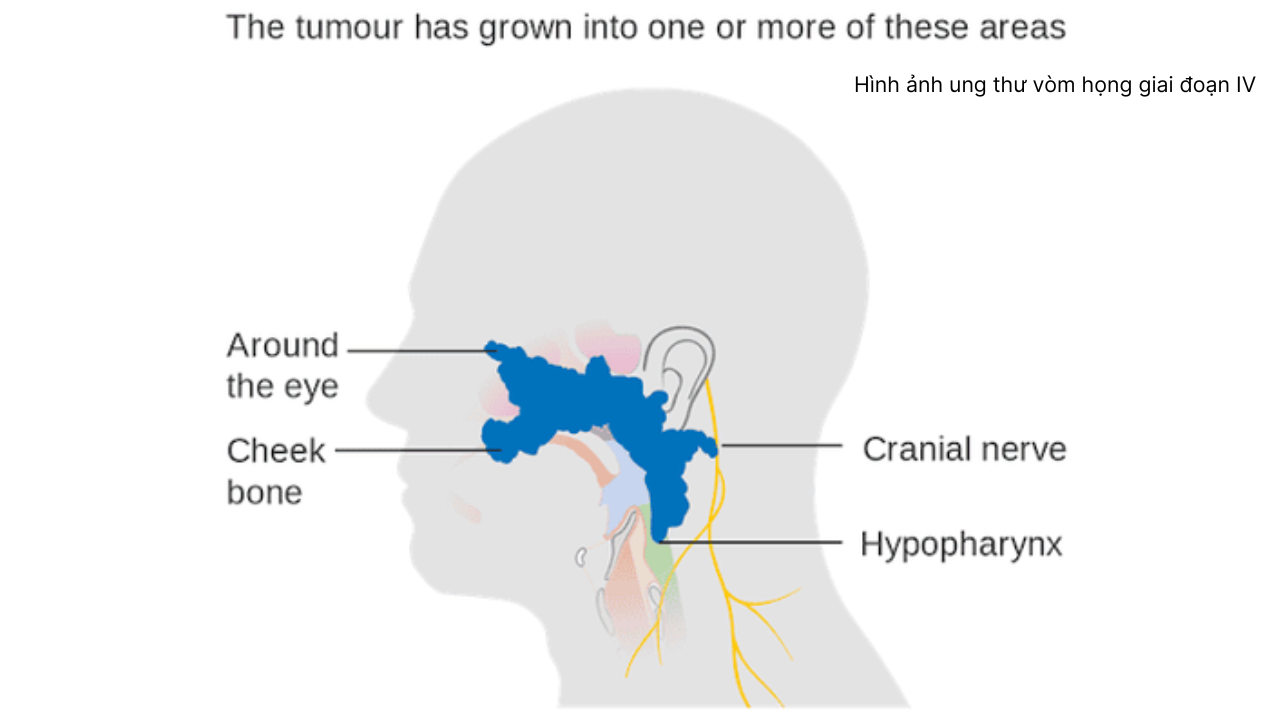 nhan-biet-hinh-anh-ung-thu-vom-hong (5).png