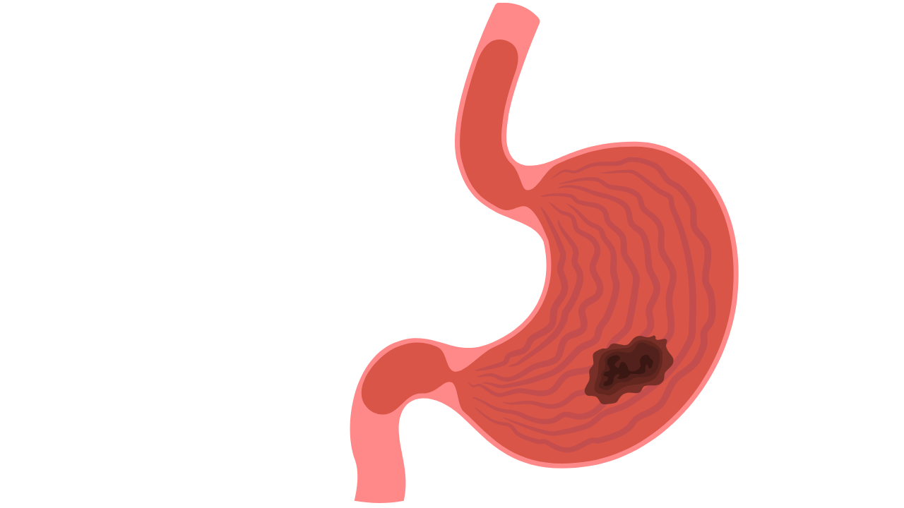 Nhận biết hình ảnh viêm hang vị dạ dày 4