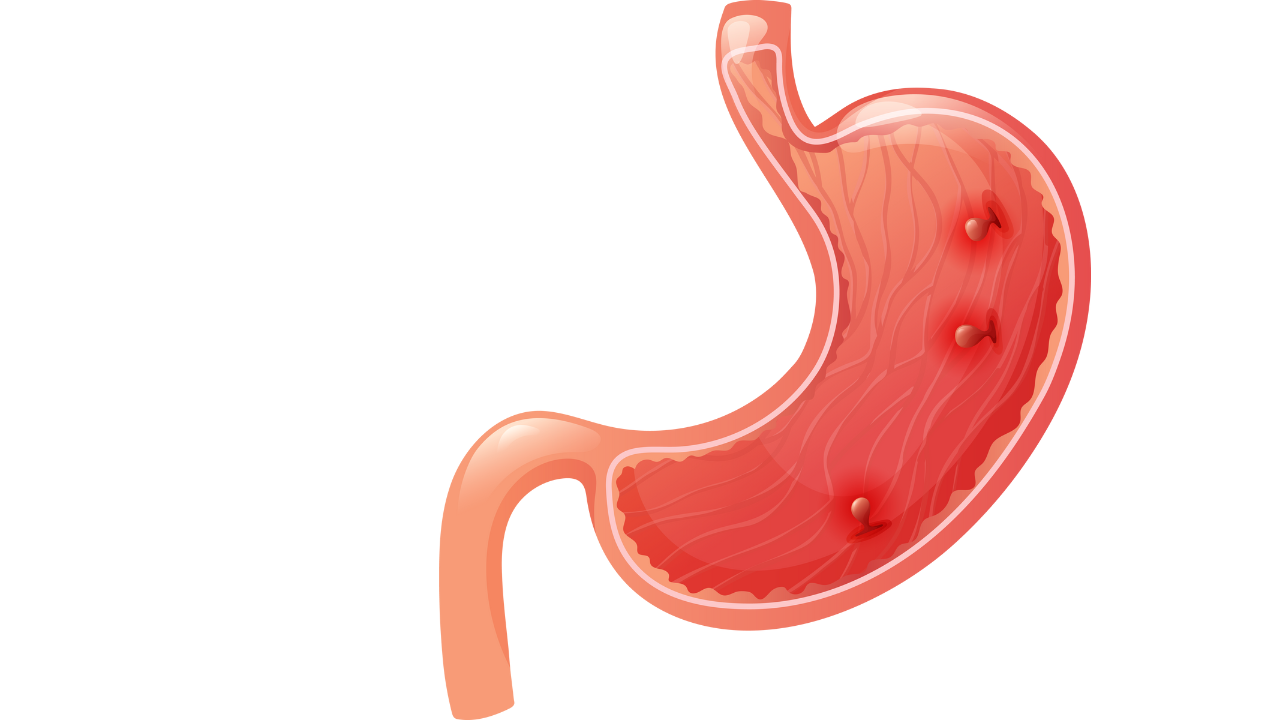 Nhận biết hình ảnh viêm hang vị dạ dày 3