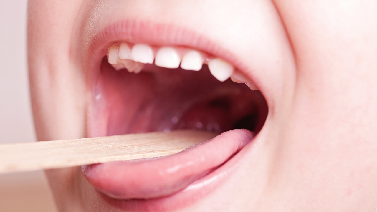 Nhận biết hình ảnh viêm họng hạt như thế nào? 2