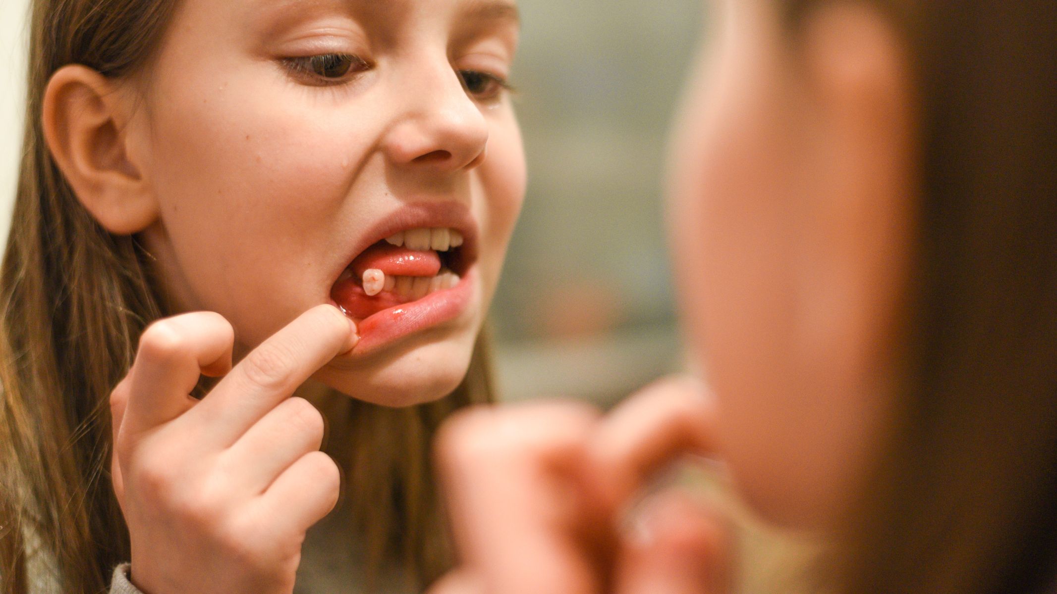 Răng lung lay hoặc rụng bất thường cũng là một dấu hiện của ung thư xương hàm