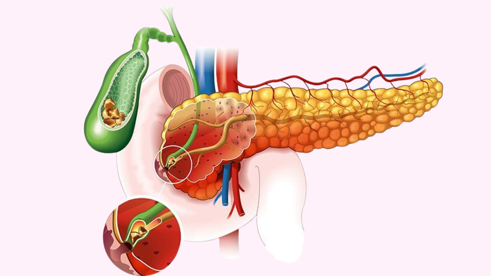 Nhận biết triệu chứng đau sỏi mật​ và cách điều trị 1