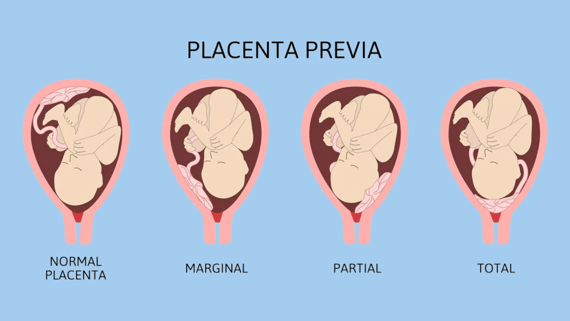 Nhau tiền đạo là tình trạng không ít mẹ bầu gặp phải
