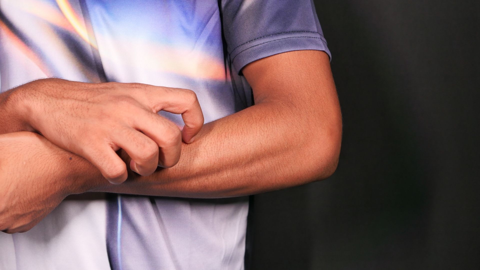 Lupus ban đỏ hệ thống có thể gây nhạy cảm ánh sáng