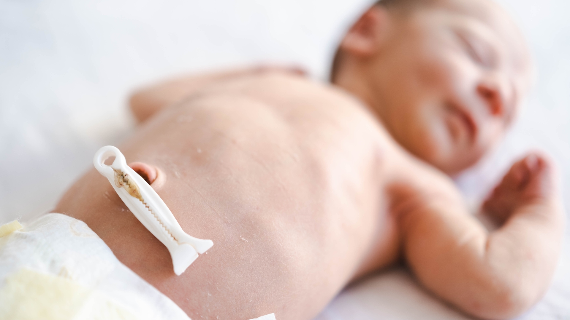 Nhiễm trùng rốn ở trẻ sơ sinh là tình trạng nhiễm khuẩn xảy ra tại vùng rốn và có thể lan rộng sang các mô xung quanh