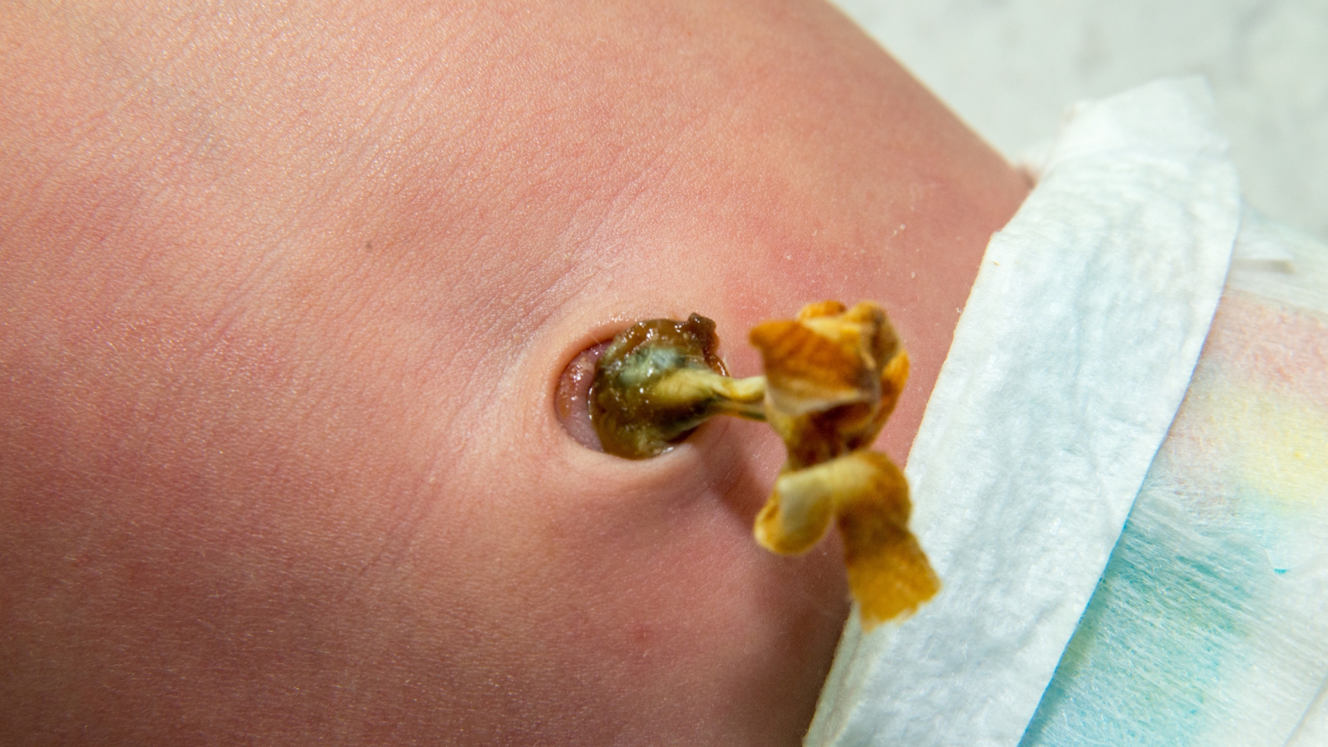 Rốn có thể tiết ra dịch màu vàng, xanh hoặc trắng đục, đôi khi đặc như mủ