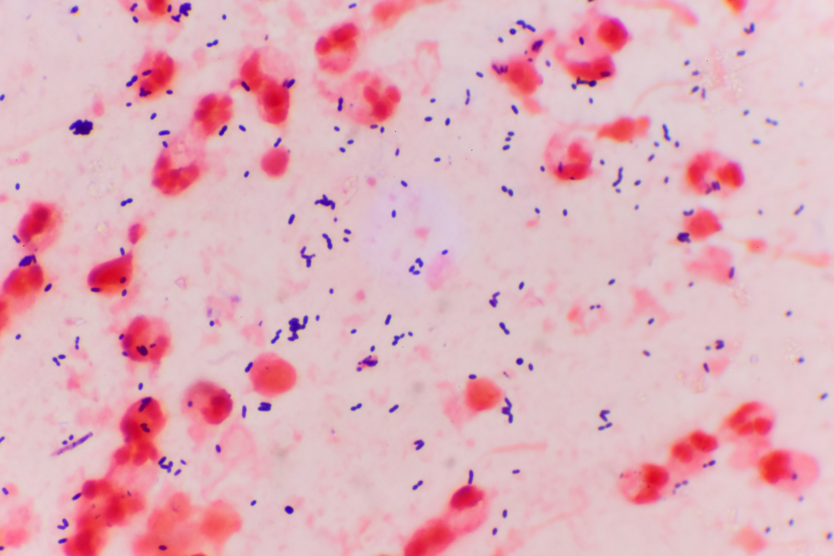 nhiem-trung-uon-van-u-benh-bao-lau-muc-do-nguy-hiem-qua-bien-chung 3.png