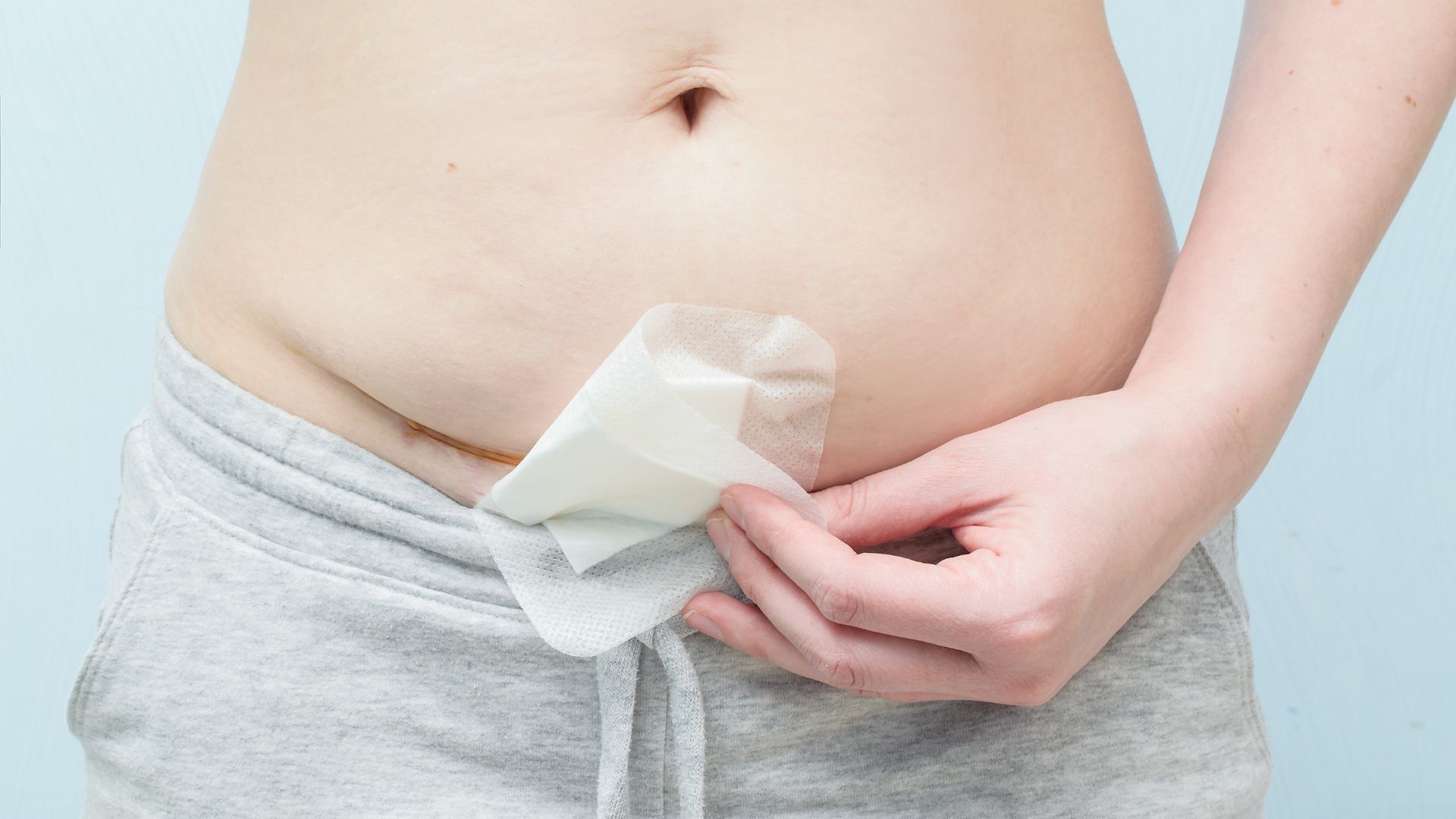 Nhiễm trùng vết mổ sau sinh được chia thành nhiều loại dựa vào mức độ tổn thương