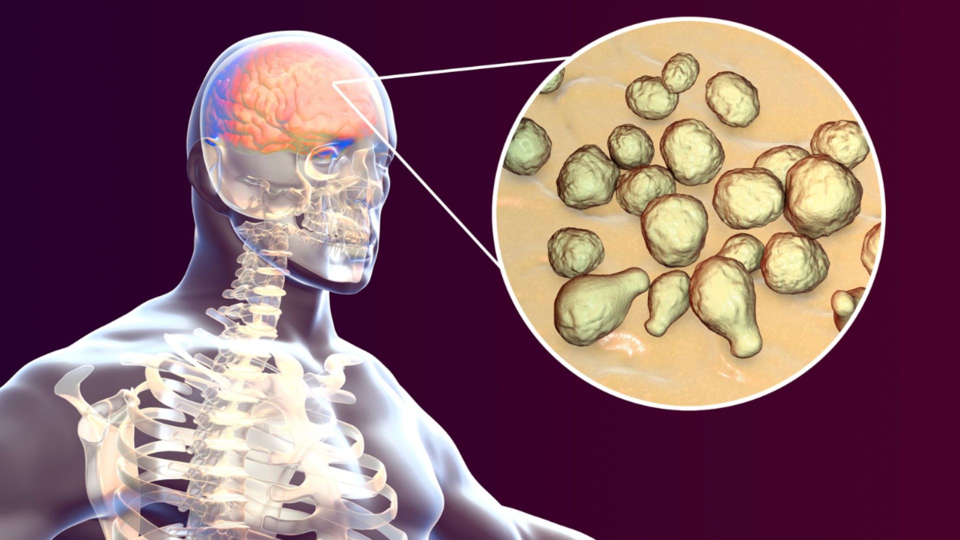 Biến chứng nội sọ là biến chứng nguy hiểm nhất của nhiễm trùng xoang