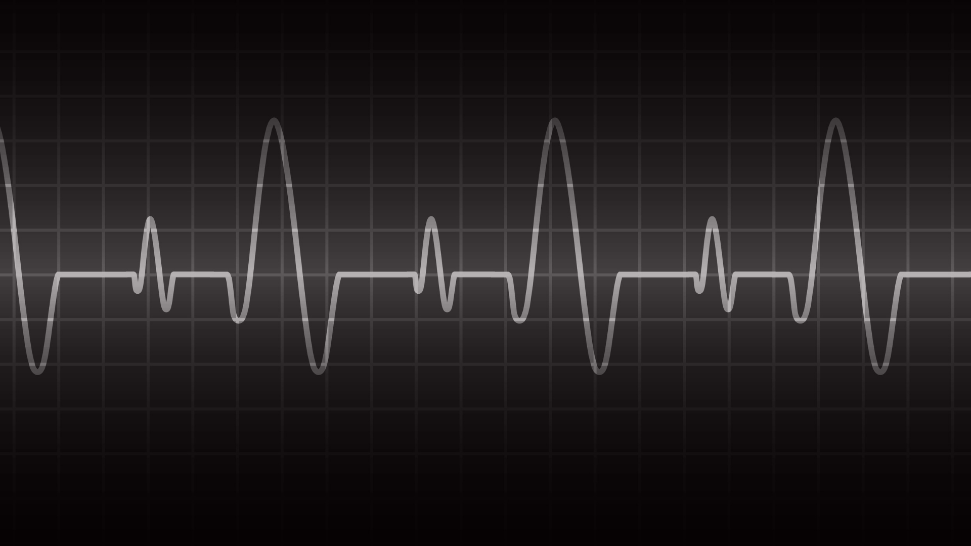 Nhịp tim nhanh là bao nhiêu theo tiêu chuẩn y tế?