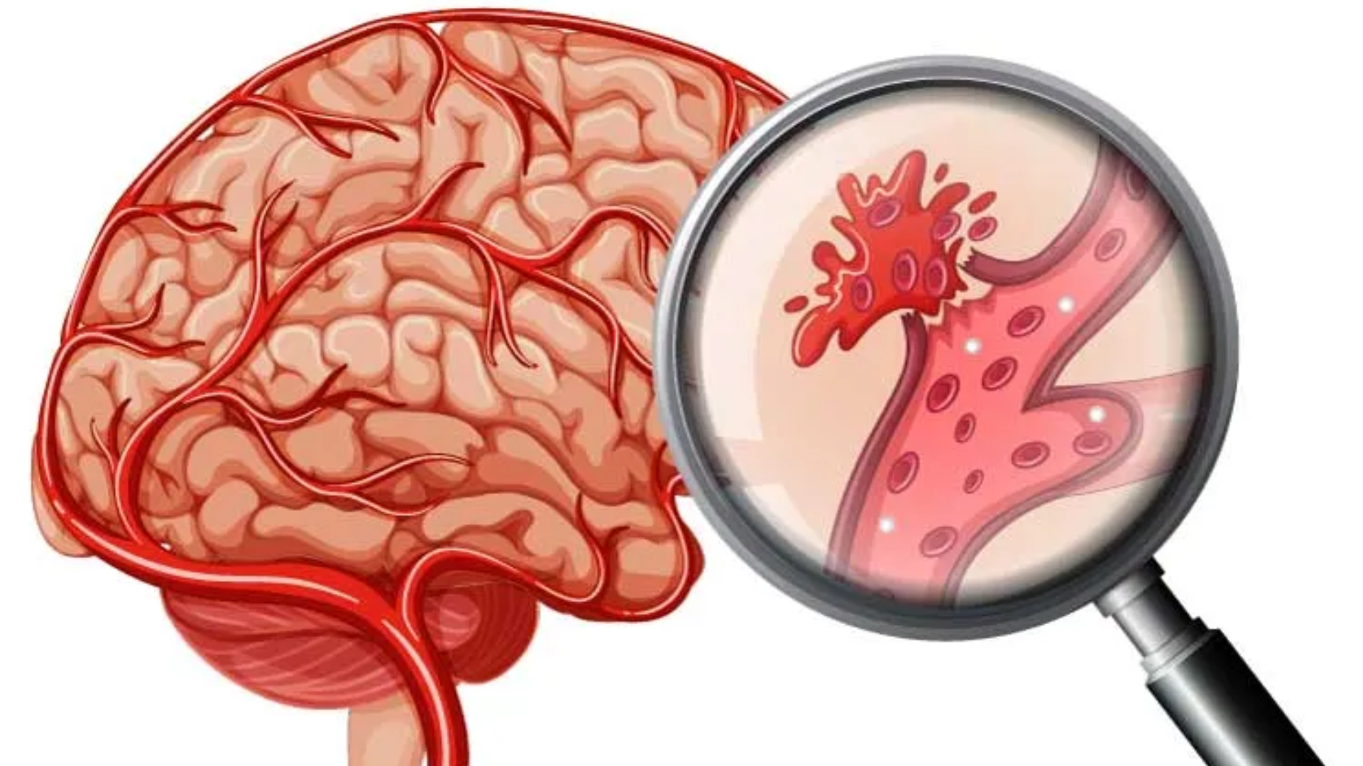 Nhồi máu não và xuất huyết não đều nguy hiểm, nhưng xuất huyết não thường có tiên lượng nặng hơn