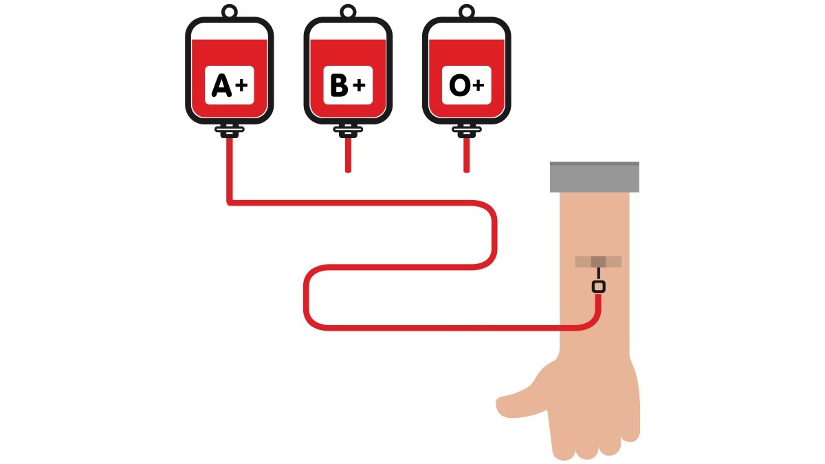 Việc tuân thủ các quy tắc truyền máu là yếu tố quan trọng để hạn chế nguy cơ ngưng kết hồng cầu