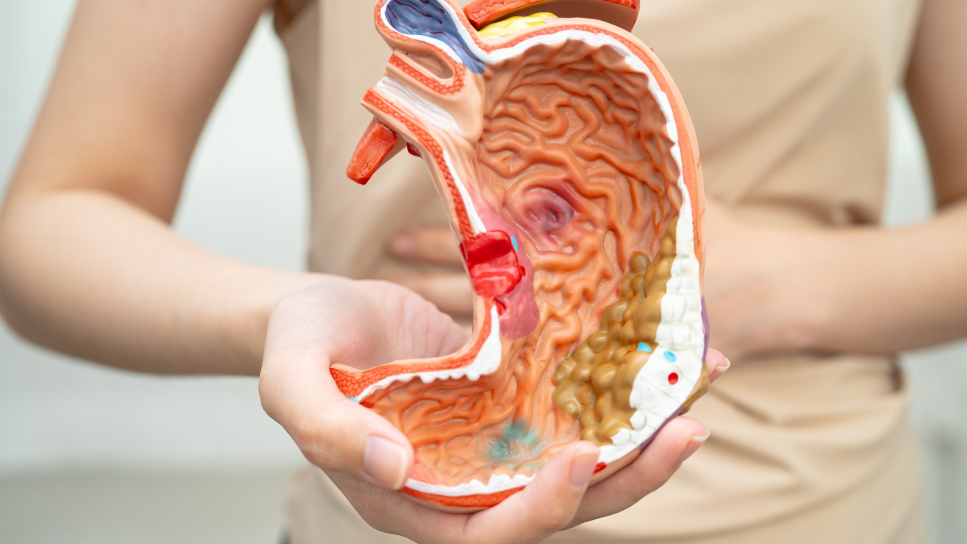 Người máu O được ghi nhận có nguy cơ loét dạ dày tá tràng cao hơn, nhưng số liệu chỉ mang tính thống kê