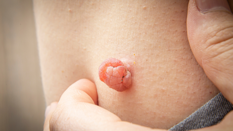 Nhũ hoa nổi mụn thịt là hiện tượng xuất hiện các nốt nhỏ quanh đầu ti