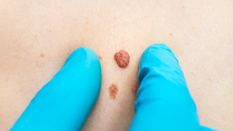 Núm vú nổi mụn thịt là hiện tượng phổ biến trong nhiều giai đoạn của nữ giới