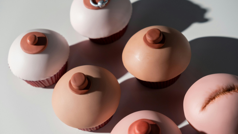 Nhũ hoa nổi mụn thịt có thể xuất phát từ thay đổi nội tiết và thói quen sinh hoạt