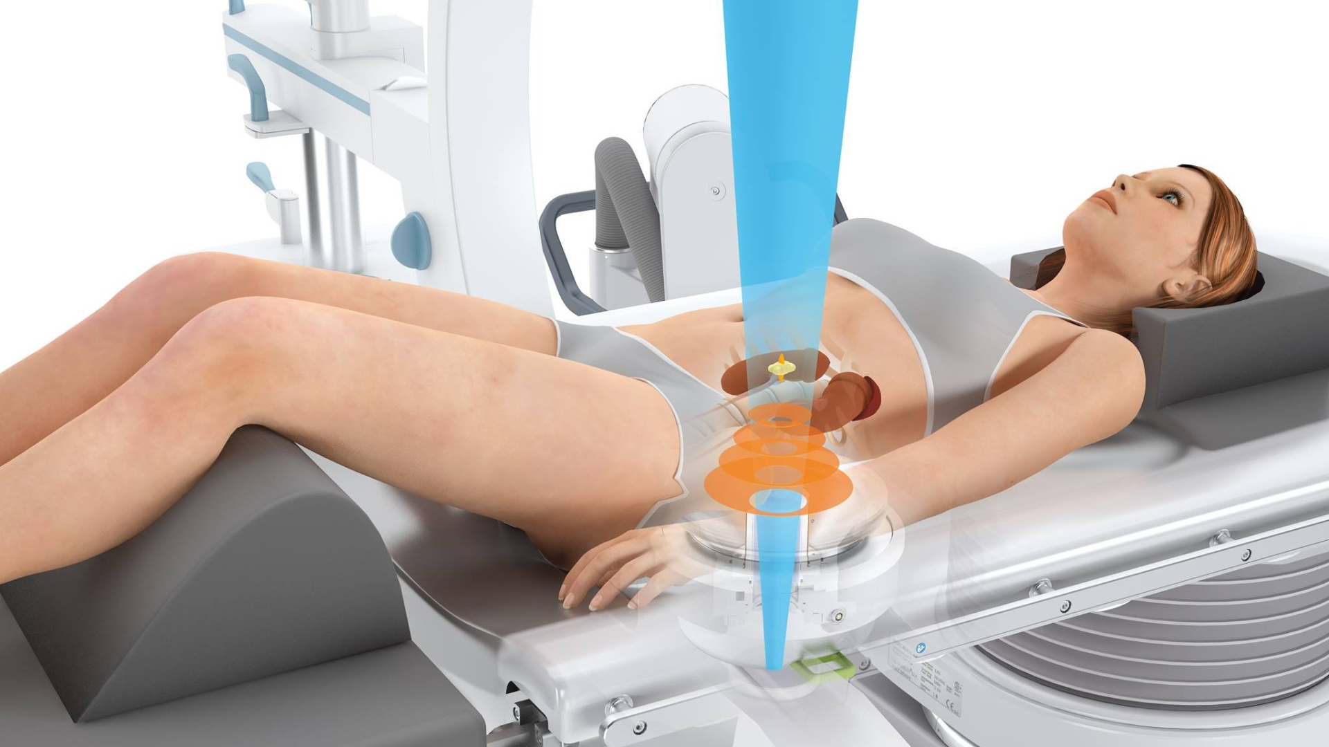 Tán sỏi ngoài cơ thể là kỹ thuật hiện đại, dùng sóng xung kích phá sỏi, giúp hồi phục nhanh