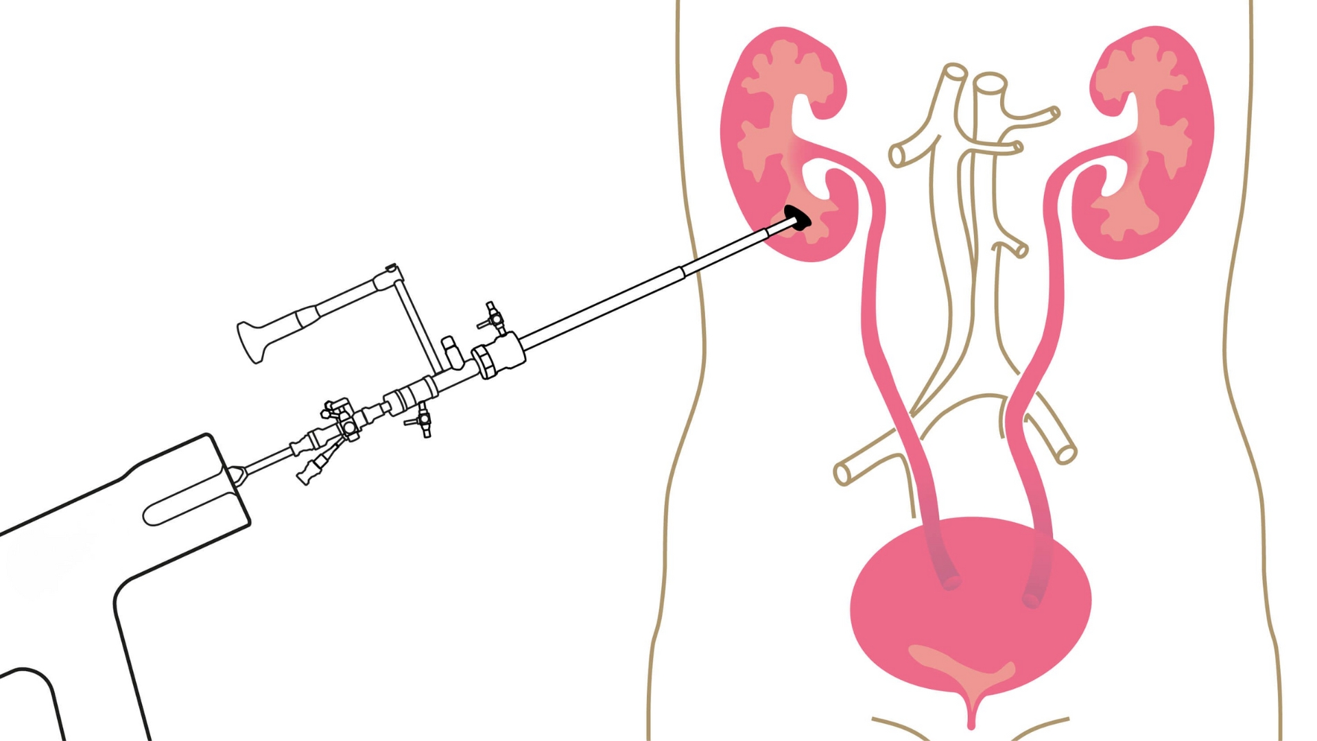 Tán sỏi qua da là một cách đẩy sỏi thận ra ngoài​
