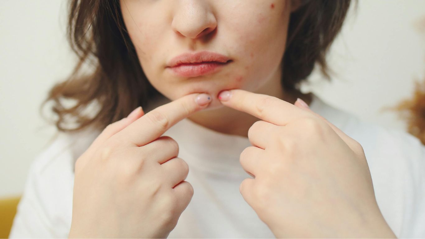 Những cách trị mụn nội tiết ở cằm đơn giản, dễ thực hiện 3