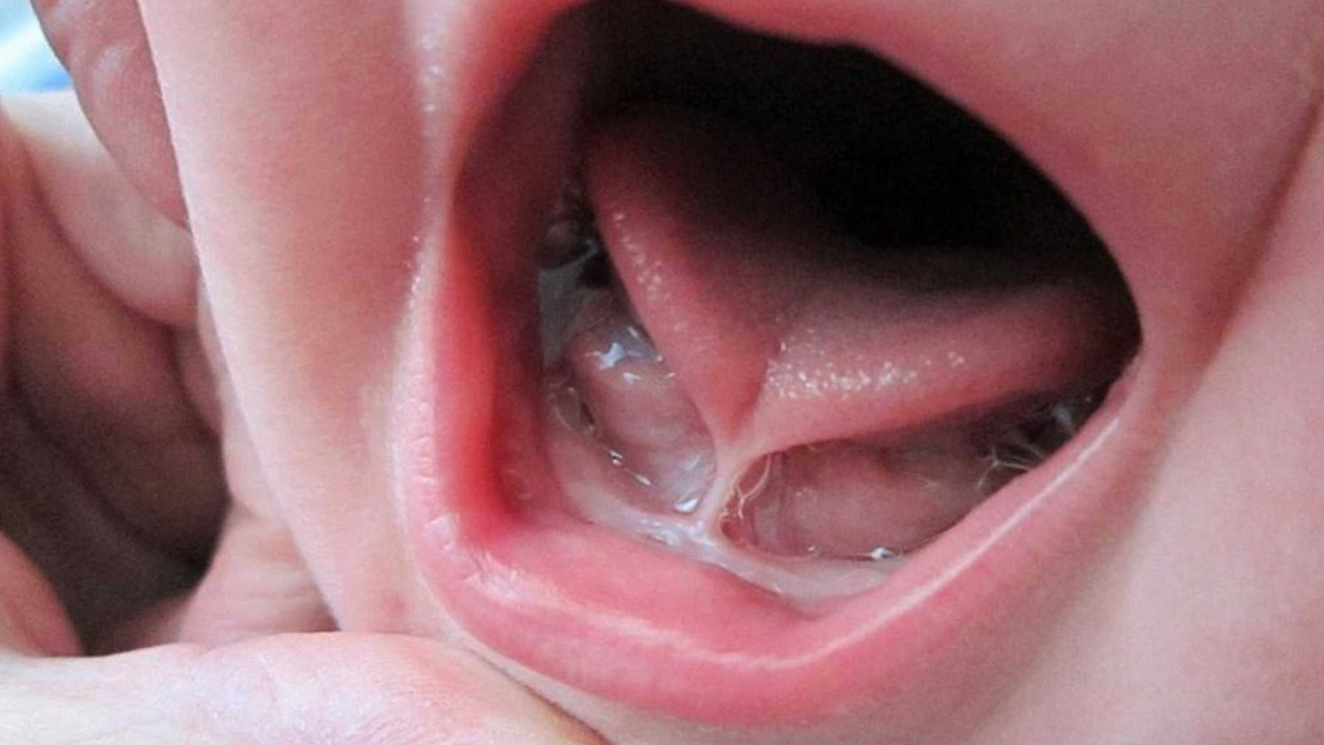 Những dấu hiệu dính thắng lưỡi ở trẻ bố mẹ cần lưu ý 2