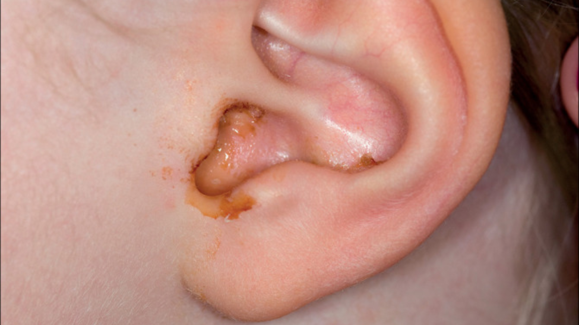 Viêm tai giữa tái phát khiến mủ tích tụ, tăng áp lực và nguy cơ thủng màng nhĩ