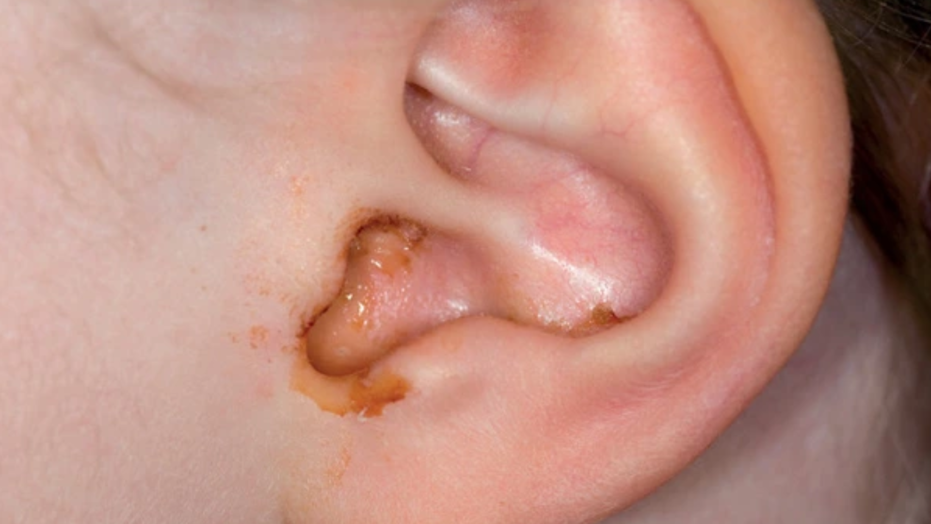 Viêm tai giữa thường gây thủng màng nhĩ ở trẻ nhỏ, cha mẹ nên biết để phòng ngừa kịp thời