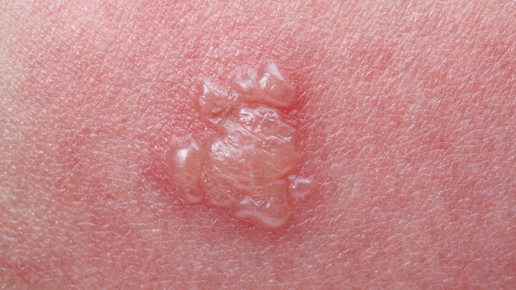 nhung-dieu-can-biet-ve-benh-zona-than-kinh-o-mat 4.png