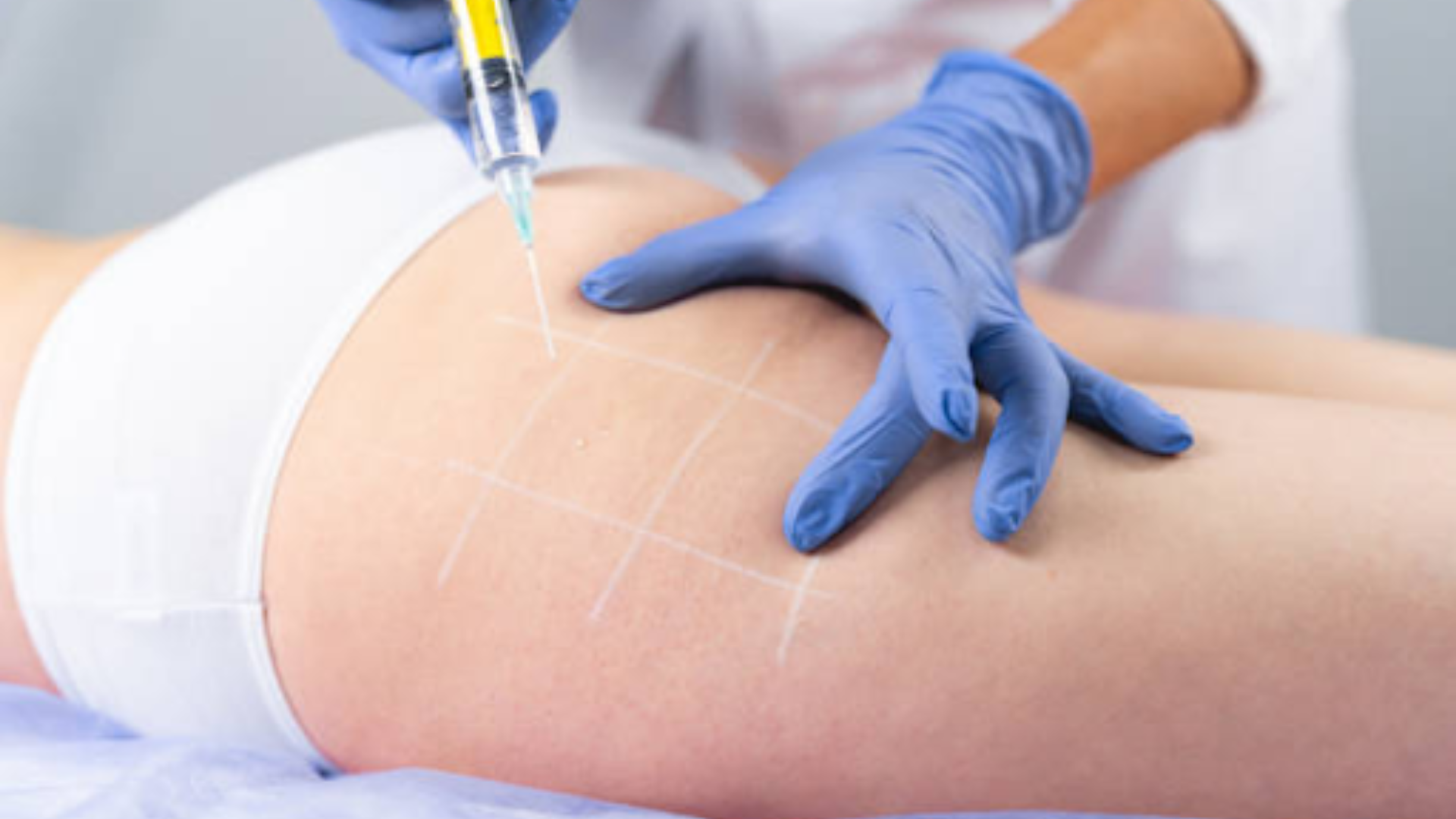 nhung-dieu-can-biet-ve-ky-thuat-tiem-mong-3