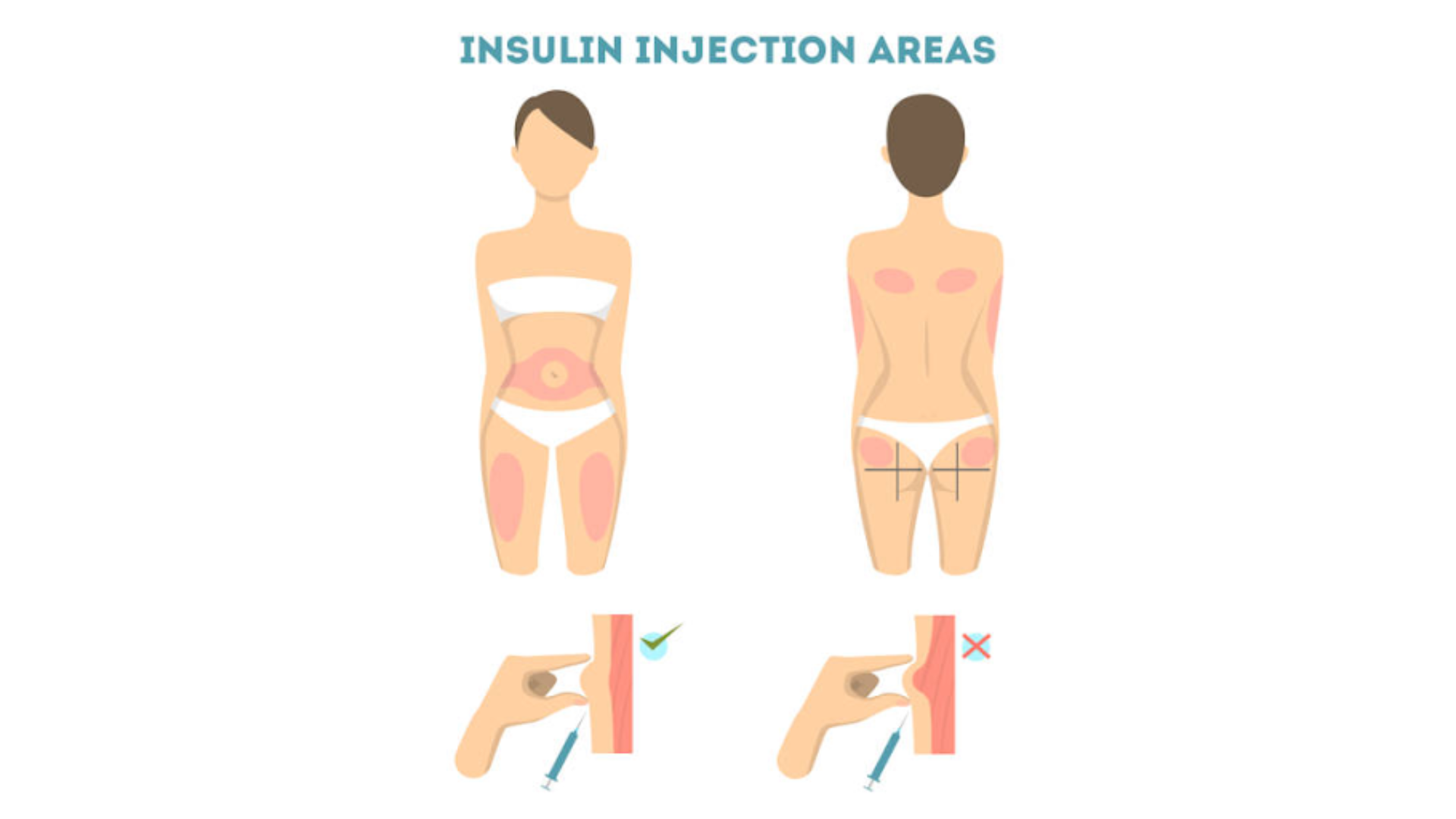 nhung-dieu-can-biet-ve-ky-thuat-tiem-mong-4