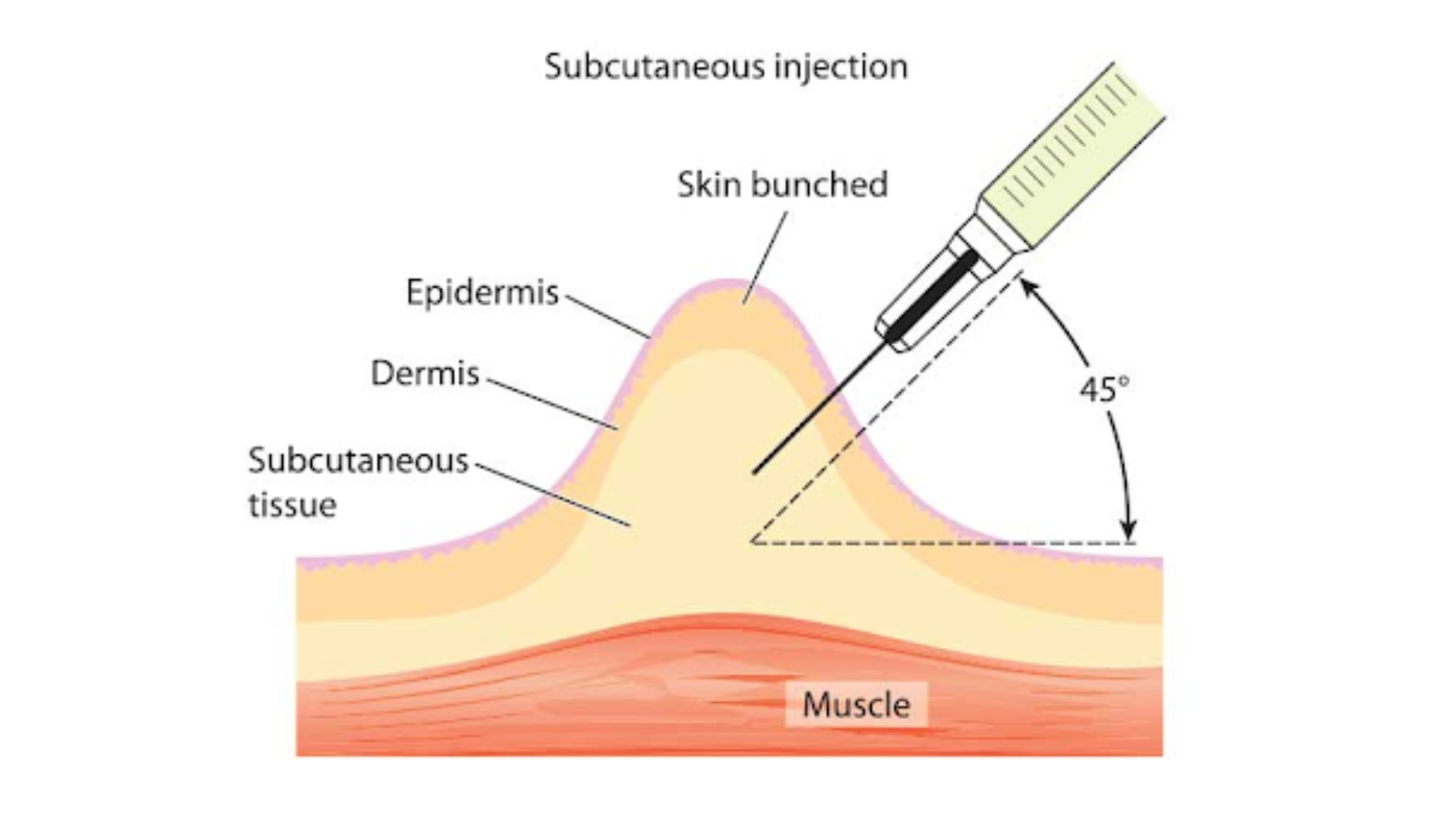 nhung-dieu-can-biet-ve-phuong-phap-tiem-duoi-da-3