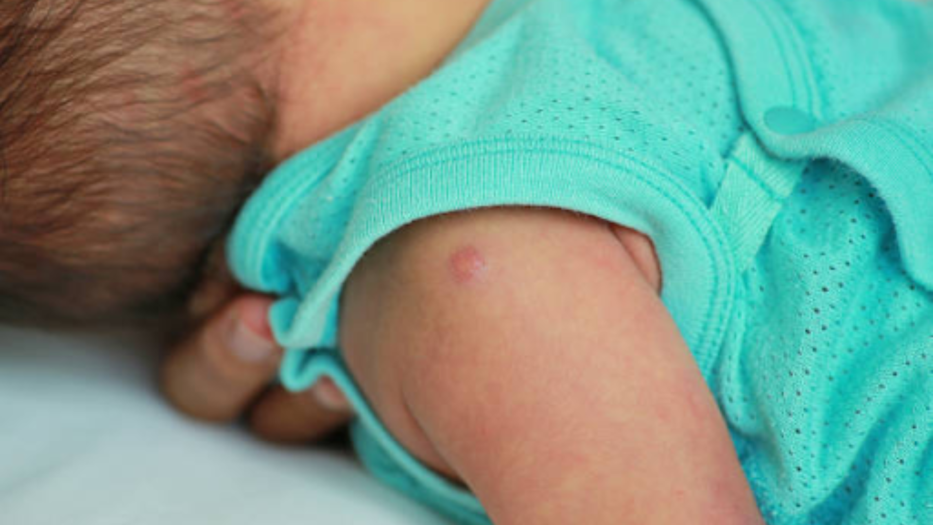 nhung-dieu-can-biet-ve-phuong-phap-tiem-duoi-da-4