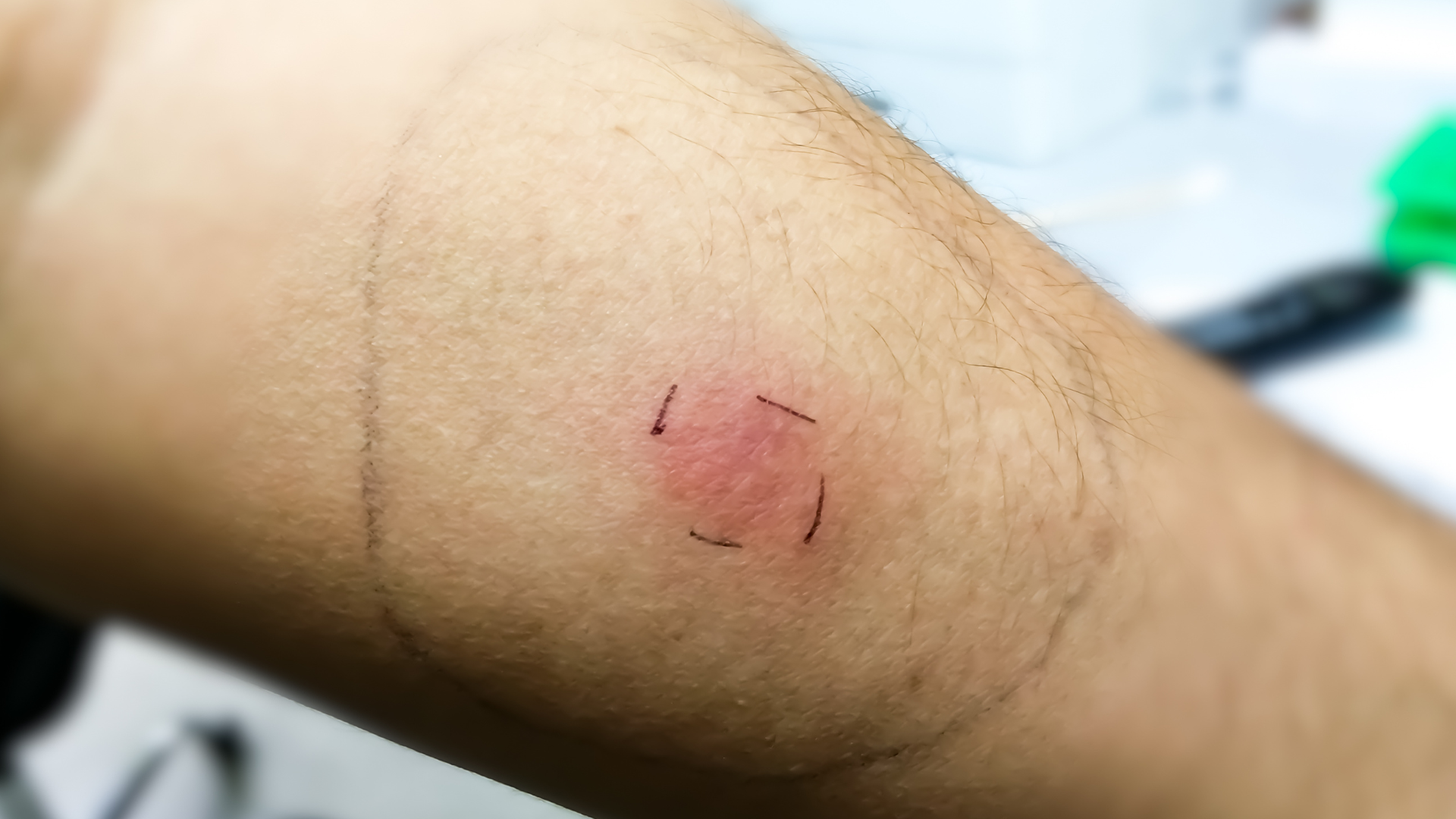 Những xét nghiệm lao phổ biến hiện nay là gì? Đối tượng nào nên xét nghiệm? 3