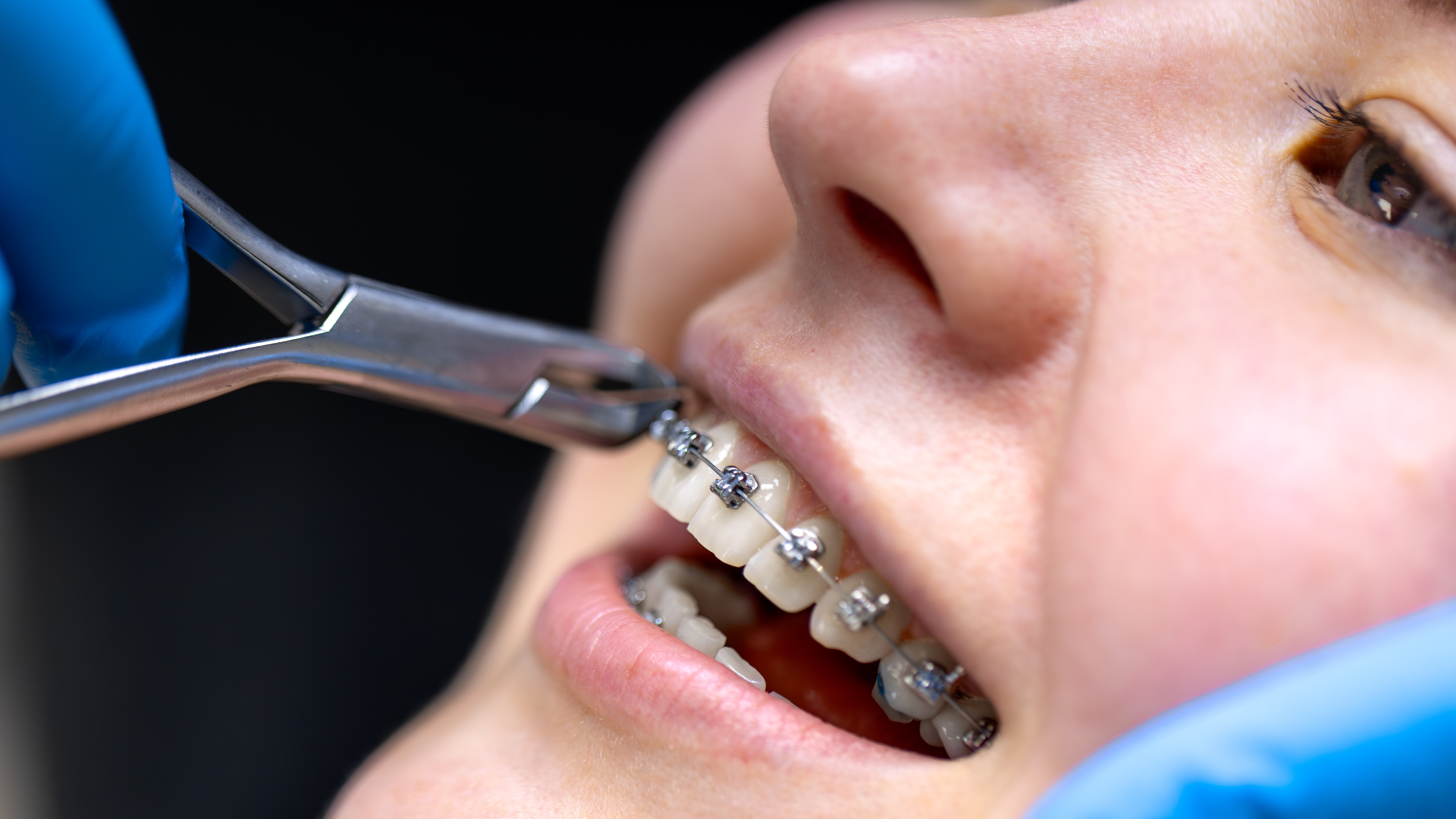 Mỗi giai đoạn niềng răng sẽ có cảm giác đau khác nhau