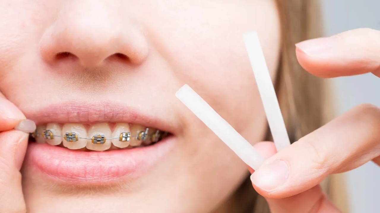 Dùng chỉ sáp nha khoa giúp giảm đau khi niềng răng