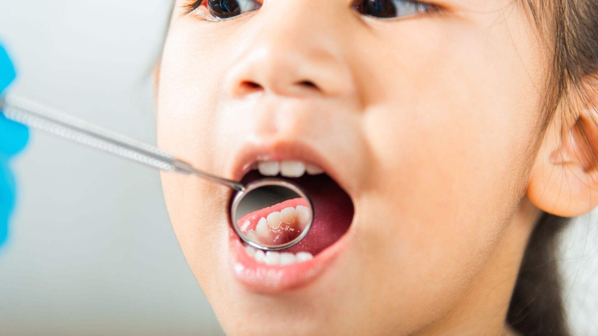 Độ tuổi niềng răng cho trẻ còn phụ thuộc vào tình trạng răng miệng và giai đoạn phát triển xương hàm của từng trẻ