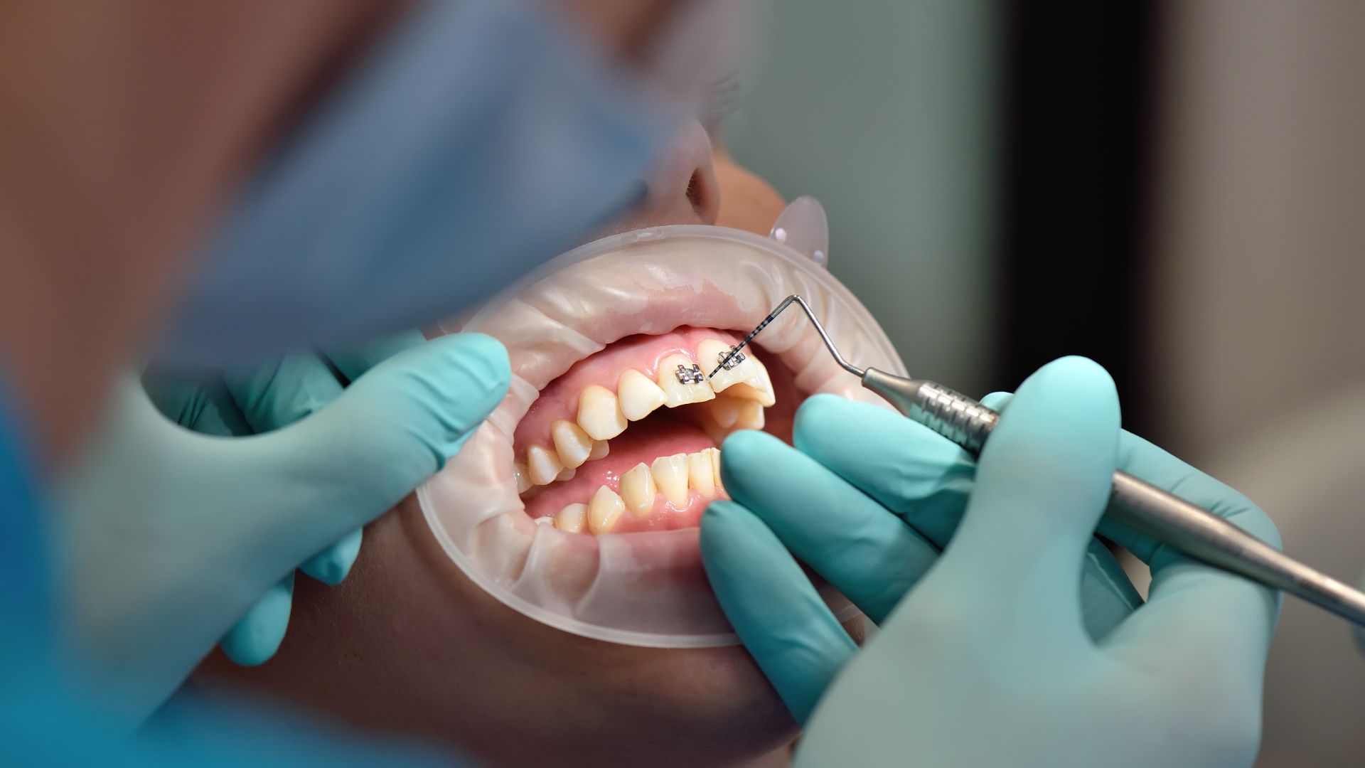 Sau khi thăm khám và lập kế hoạch điều trị, bác sĩ sẽ tiến hành gắn khí cụ chỉnh nha cho trẻ