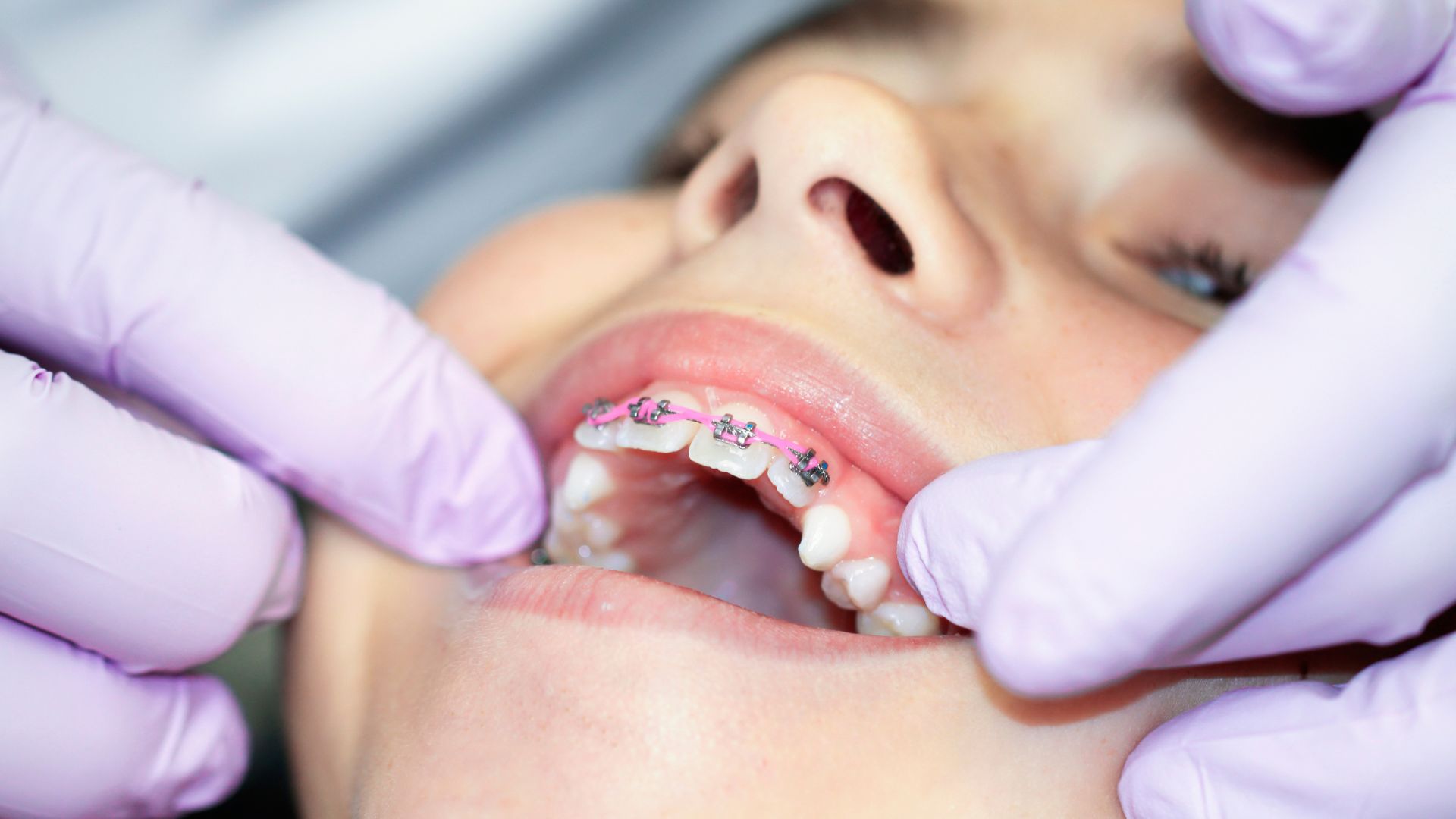 Xương hàm của trẻ còn đang tăng trưởng nên bác sĩ có thể can thiệp định hướng sự phát triển này bằng các khí cụ chức năng