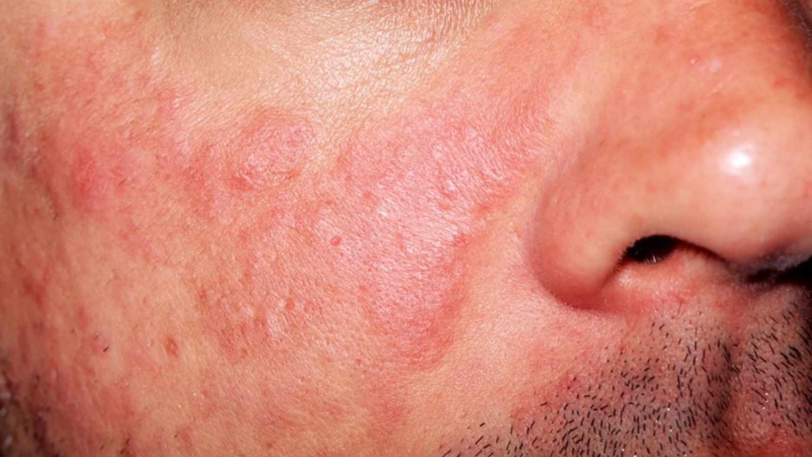 Nổi hạch vùng má là phản ứng của hệ miễn dịch khi cơ thể đang chống lại nhiễm trùng, viêm hoặc các tác nhân bất thường khác