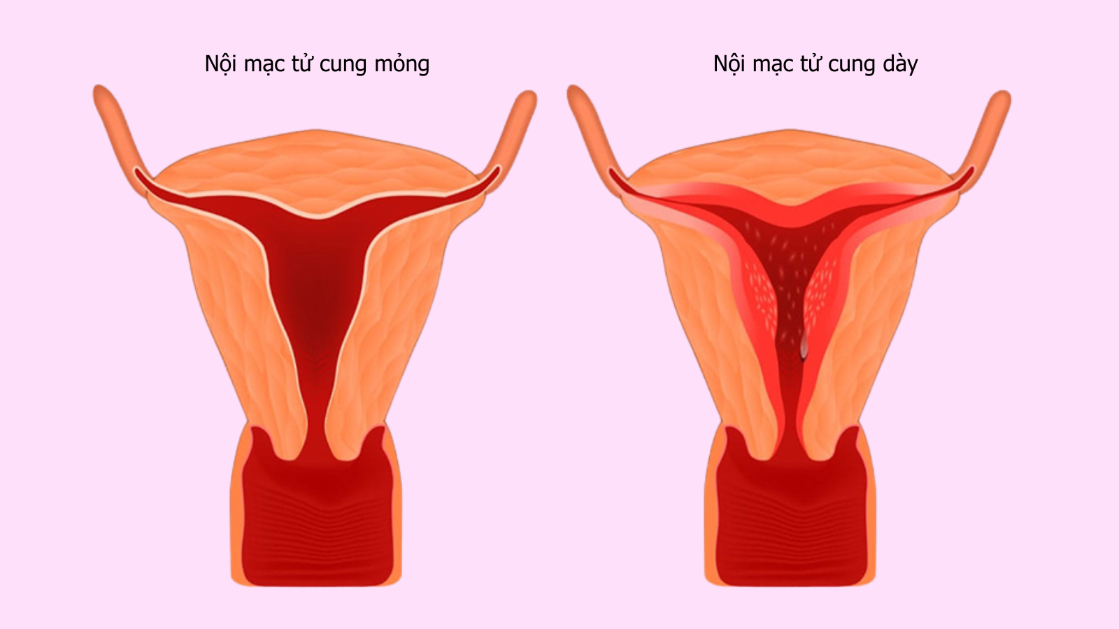 Độ dày nội mạc tử cung ảnh hướng lớn đến khả năng sinh sản của nữ giới