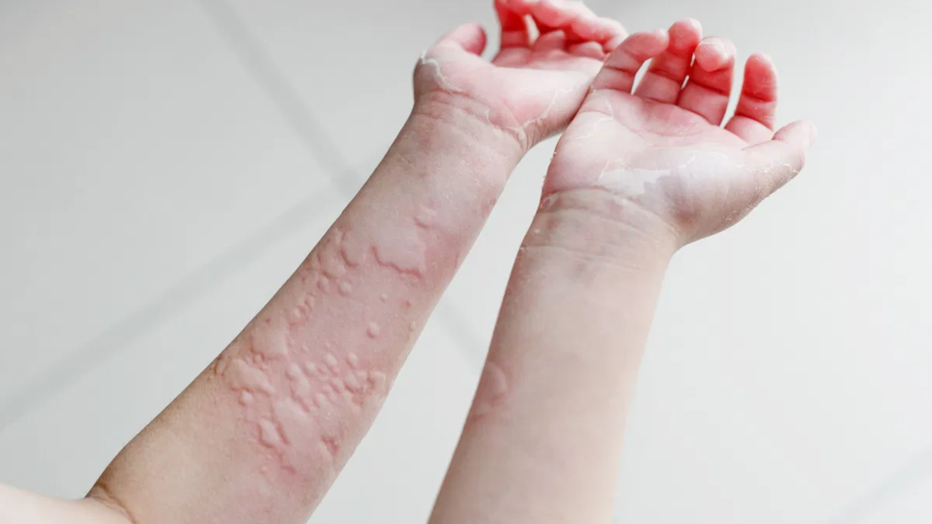Nổi mề đay là gì? Nguyên nhân, triệu chứng và cách điều trị2