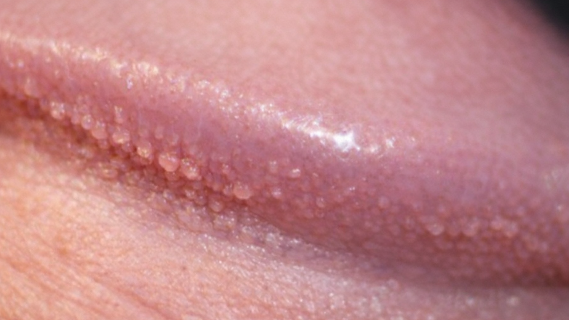 Tìm hiểu nguyên nhân nổi mụn nhỏ trắng ở rãnh bao quy đầu để xử lý đúng cách