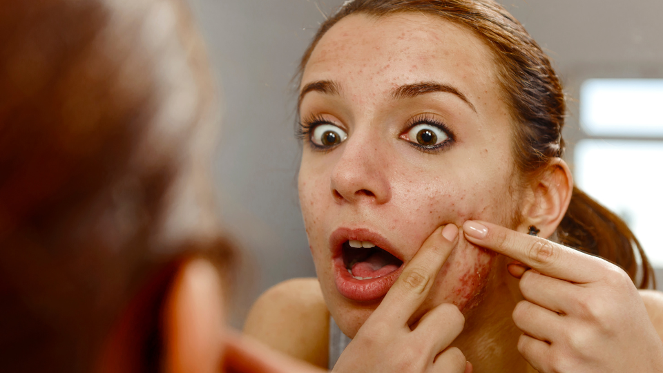 Nổi mụn nhọt liên tục: Dấu hiệu cảnh báo sức khỏe bạn không nên bỏ qua 2