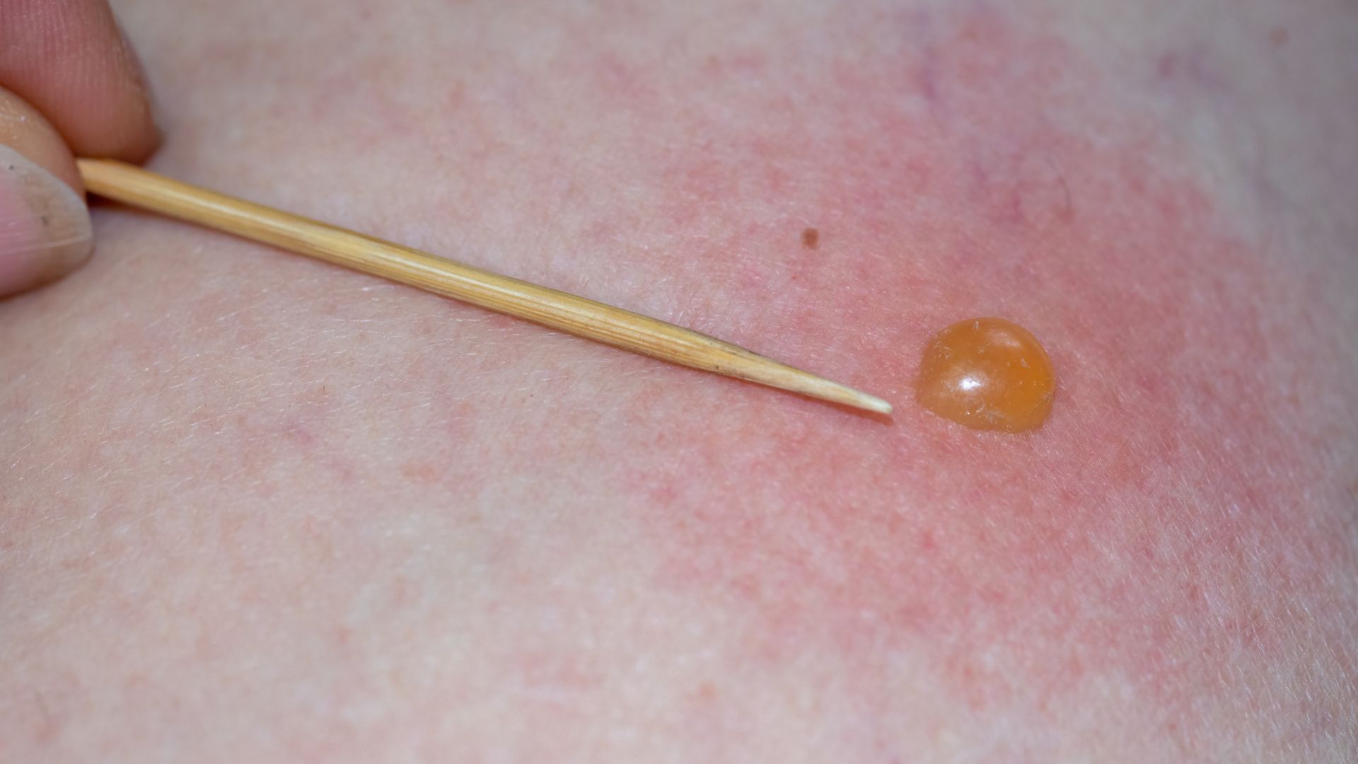 Côn trùng cắn cũng là một trong những nguyên nhân gây nổi mụn nước