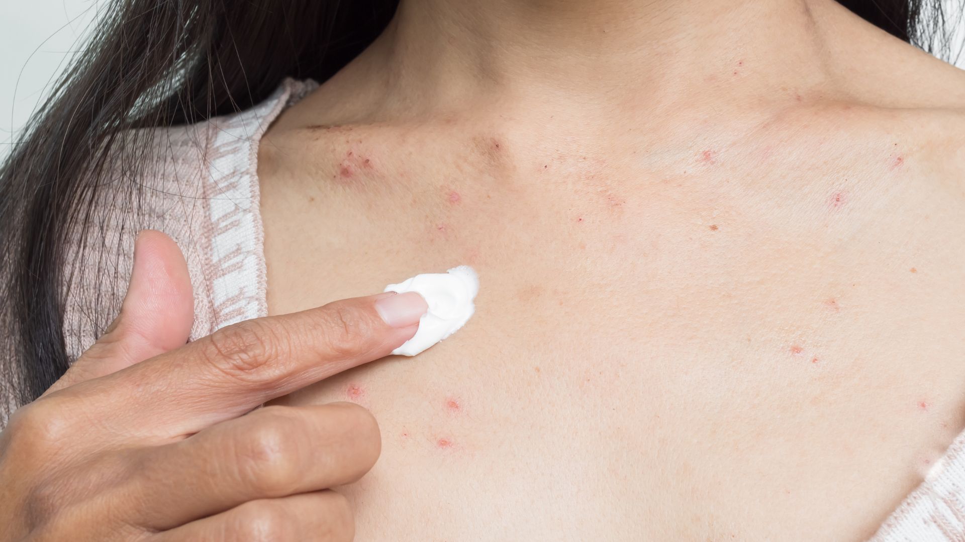 Chỉ dùng thuốc bôi chứa steroid hoặc kháng sinh khi có chỉ định của bác sĩ sau thăm khám